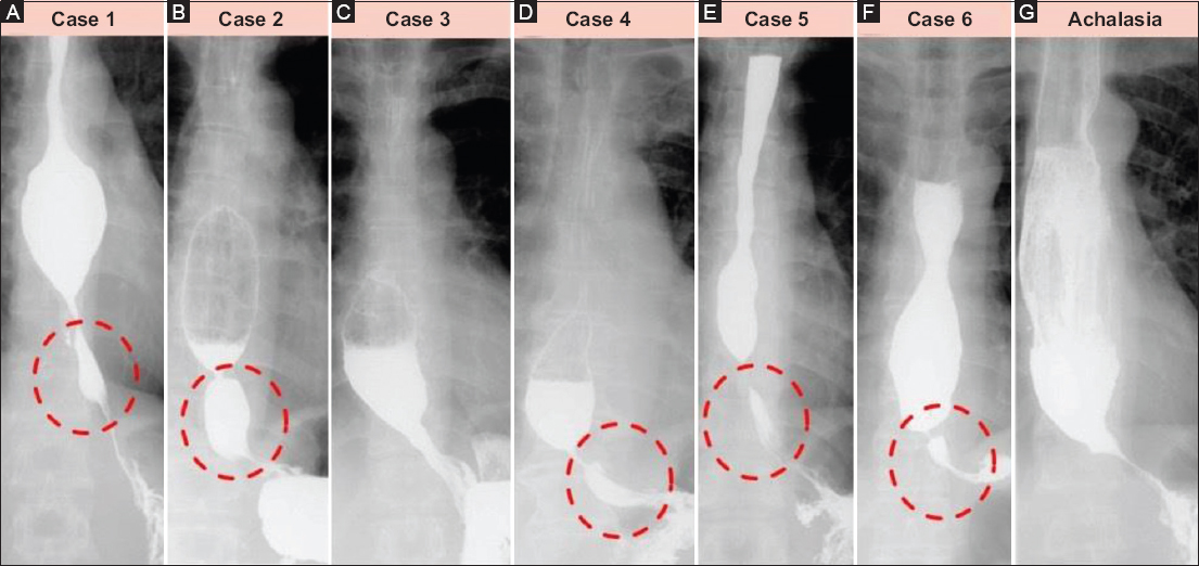 esophageal stenosis